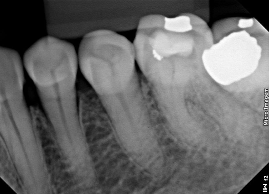 Caso Clínico molar inferior 5 canais Blog Dental Cremer