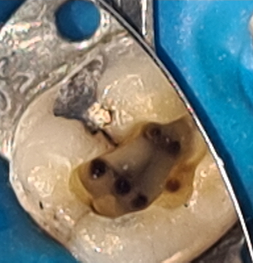 Caso Clínico molar inferior 5 canais Blog Dental Cremer Henry