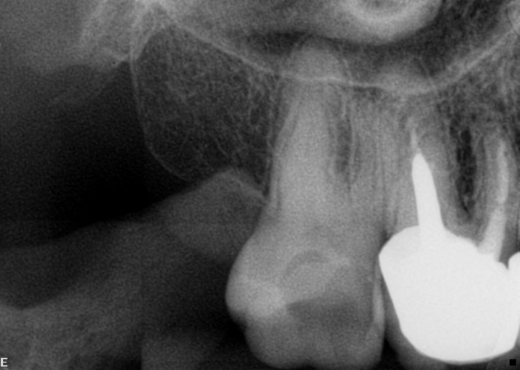 Instrumentação de canais radiculares curvos ou atrésicos Blog Dental