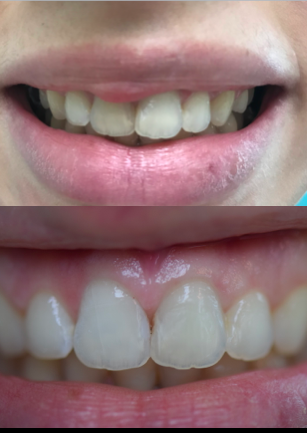 Radiograf  Mitos e verdades sobre o aparelho Invisalign