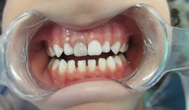 Traumatismo em dentes decíduos: o que fazer quando ocorre alteração de cor?