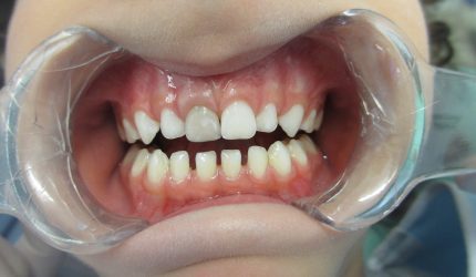 Alteração de cor em dentes decíduos após traumas