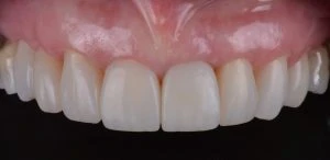 Caso Clínico: harmonização de sorriso com Charisma Diamond