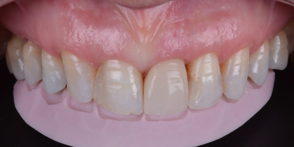 Utilização de guia palatina para orientar as reconstruções das bordas incisais.Utilização de guia palatina para orientar as reconstruções das bordas incisais.