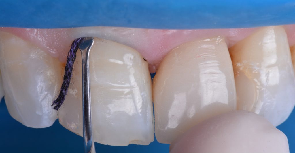 Isolamento relativo com o uso de fio afastador para facilitar a reconstrução cervical.