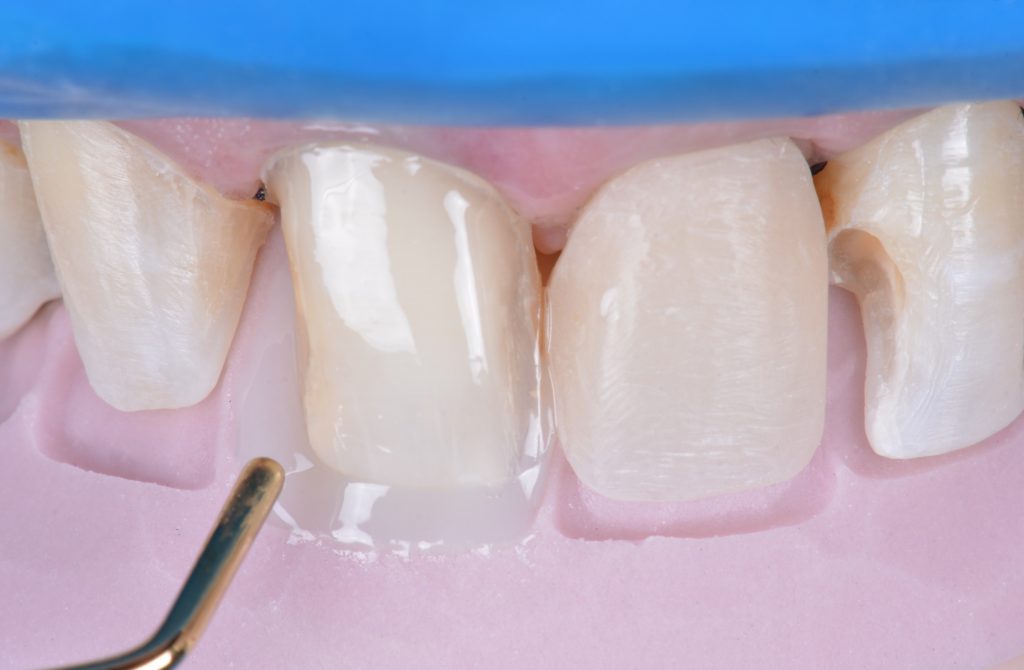 Estratificação da face palatina com a resina Charisma Diamond CL (Kulzer).