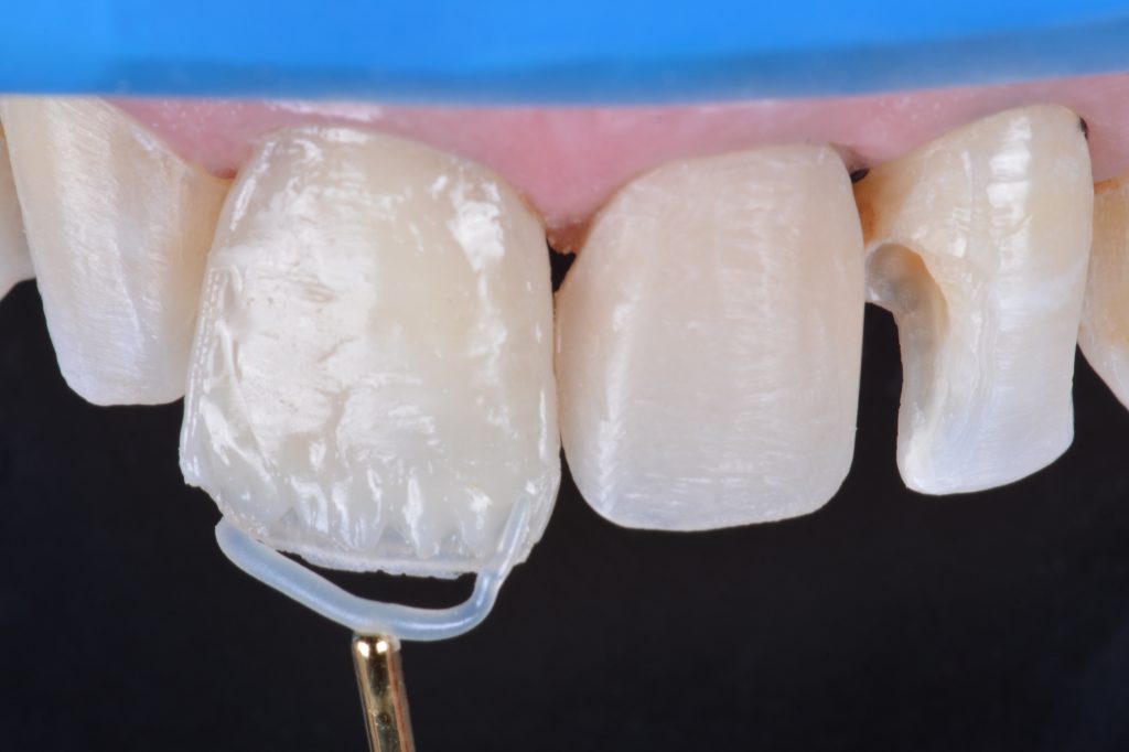 Estratificação da dentina com a resina OM e do halo opalescente com a resina Charisma Diamond CO (Kulzer).