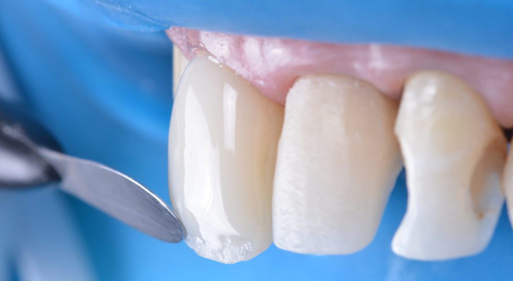 Estratificação do esmalte cromático com a resina Charisma Diamond A2 (Kulzer).