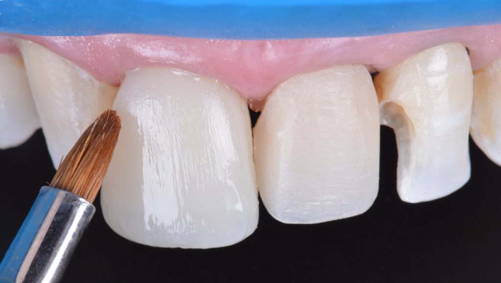 Finalização da estratificação com pincel.
