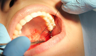 Caso clínico: curativo alveolar para estimular regeneração óssea em exodontias
