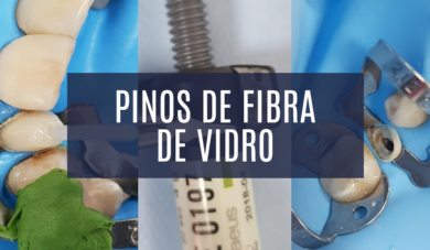 Nem só de beleza vivem os Pinos de Fibra de Vidro