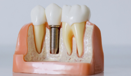 Você sabe qual paciente não pode fazer implante dentário?