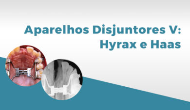 Aparelhos ortodônticos V: disjuntores palatinos Hyrax e Haas