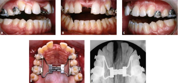 Imagem mostrando diferentes etapas de correção ortodôntica em dentes infantis, incluindo fotografias e radiografia com aparelho ortodôntico Hyrax para corrigir mordida e alinhamento dentário