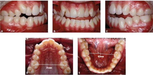 Imagem mostrando diferentes estágios e detalhes da estrutura dental de uma pessoa, incluindo medidas em milímetros da arcada superior e inferior, com foco na correção ortodôntica com a utilização do aparelho Hyrax. Ideal para estudos odontológicos e tratamentos de ortodontia.