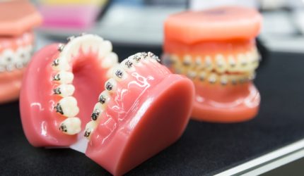 A Movimentação Dentária e a Ortodontia