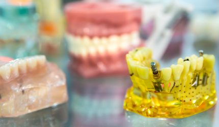 10 dicas para você não passar apuros com implantes dentários