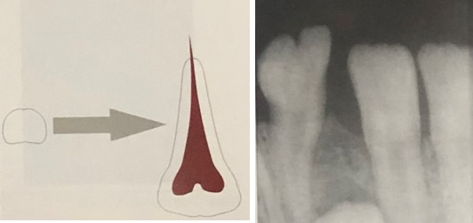 geminação dental