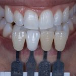 Dentes do paciente após finalização do protocolo de clareamento dental