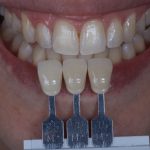 Dentes do paciente antes de iniciar o protocolo de clareamento dental
