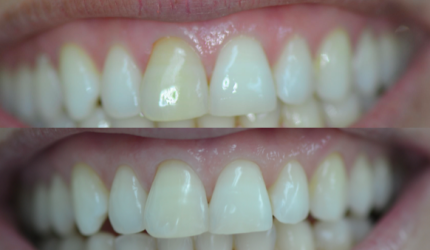 Clareamento interno em dentes despolpados realmente funciona?