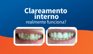 Clareamento interno em dentes despolpados realmente funciona?