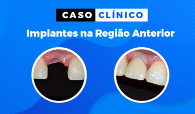 Caso clínico: condicionando tecido perimplantar