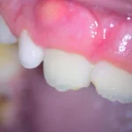 Imagem detalhada de dentes e gengivas, destacando uma possível condição periodontal com inflamação visível nas gengivas.