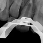 Radiografia dental mostrando a estrutura de suporte de um implante em odontologia. A imagem ilustra o posicionamento correto para tratamento dental.