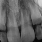 Radiografia odontológica mostrando detalhes das raízes dos dentes, utilizada para diagnósticos em odontologia.