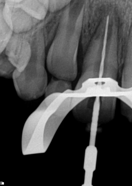 Radiografia de dentes mostrando detalhe do tratamento de canal, com ênfase na ferramenta utilizada. Ilustração dos procedimentos odontológicos modernos.