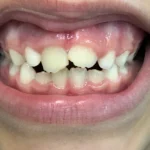 Imagem de um sorriso com dentes em desenvolvimento, mostrando dentes decíduos e uma incisivo em formação. Ótima para informações sobre saúde bucal.