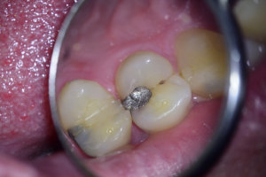 Dente gretado com uma restauração e cárie