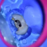 Imagem que mostra uma cavidade dental com um seccionamento que destaca a estrutura interna de um dente, ideal para discussões sobre saúde bucal e cuidados dentários.