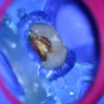 Imagem em close de um dente com cárie, mostrando a decomposição e a necessidade de tratamento odontológico. Ideal para conscientização sobre saúde bucal.