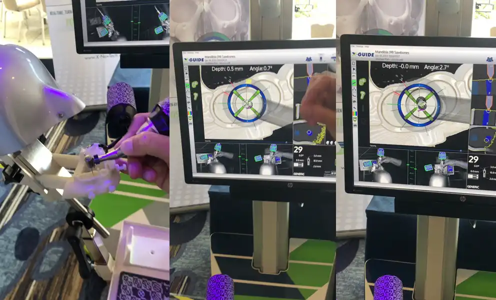 Imagem mostrando um robô cirúrgico com tela interativa que exibe dados de profundidade e ângulo, exemplificando tecnologia de assistência cirúrgica