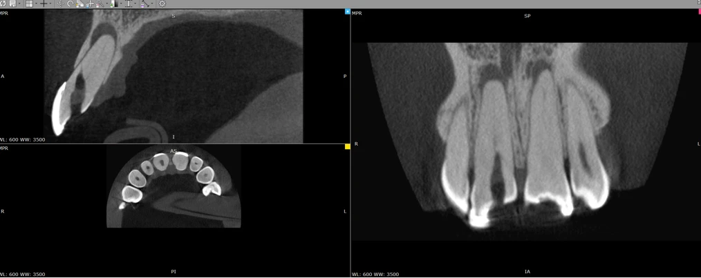 Imagem ilustrativa de imagens de tomografia computadorizada, mostrando cortes de um dente e estruturas odontológicas.