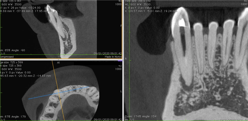 Imagem ilustrativa de imagens de tomografia computadorizada, mostrando cortes de um dente e estruturas odontológicas.