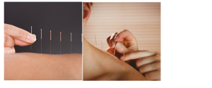 Práticas Integrativas e Complementares utilizando acupuntura no tratamento odontológico 