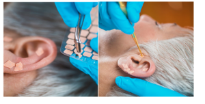 Práticas Integrativas e Complementares utilizando a auriculoterapia