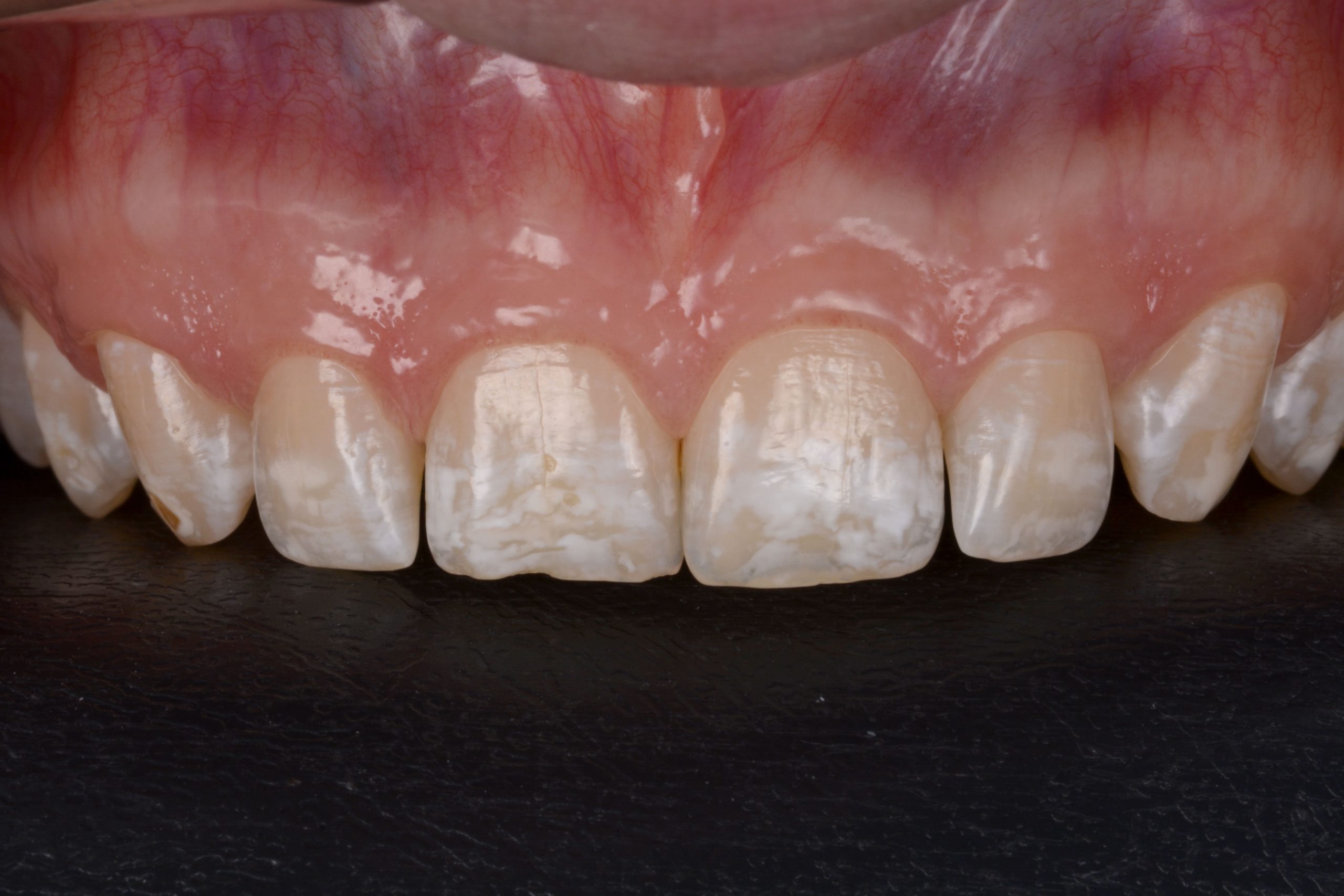 Diagnóstico de fluorose dental em grau moderado com presença de manchas mais intensas entre os dentes 13 ao 23