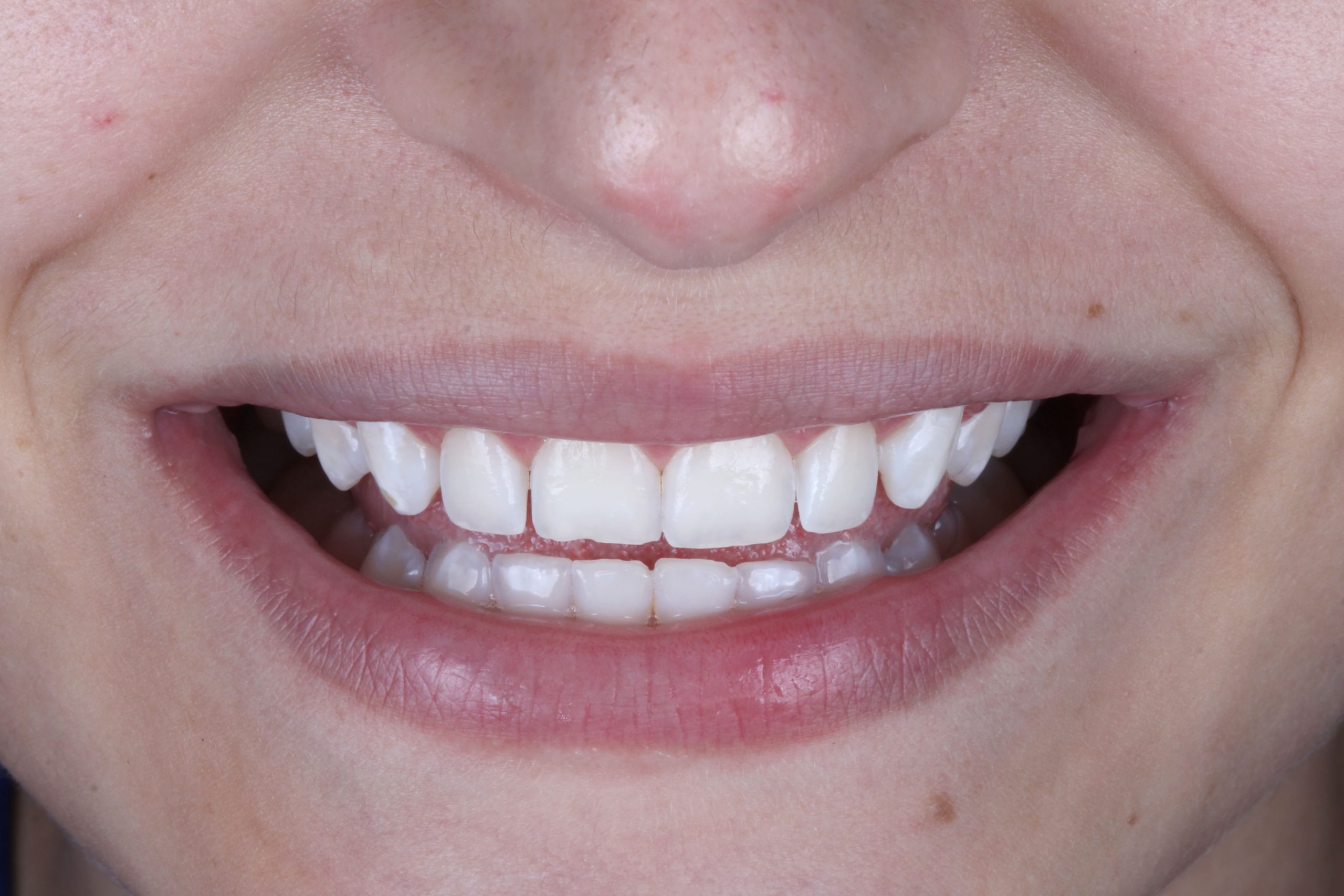 sorriso final da paciente sem a fluorose dental
