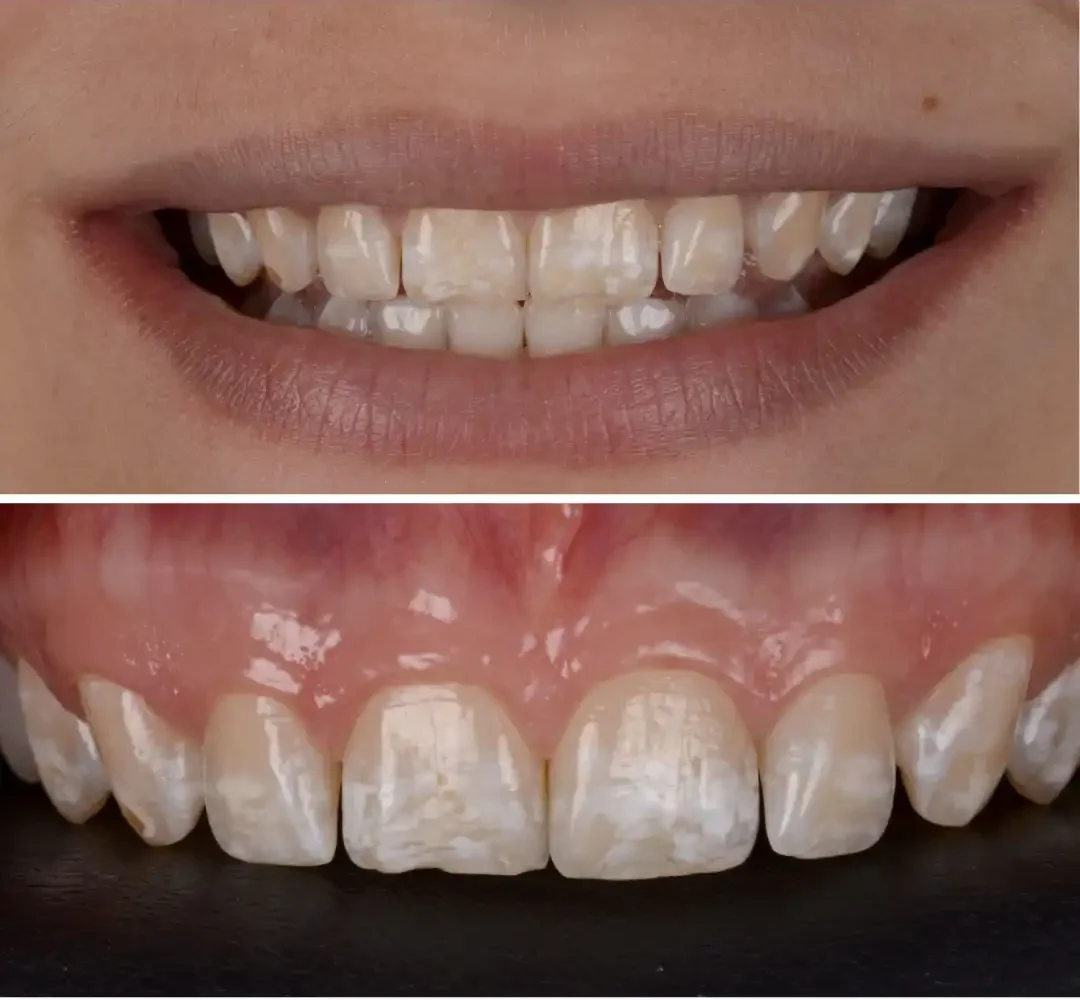 Sorriso inicial da paciente que ira realizar o tratamento para fluorose dental