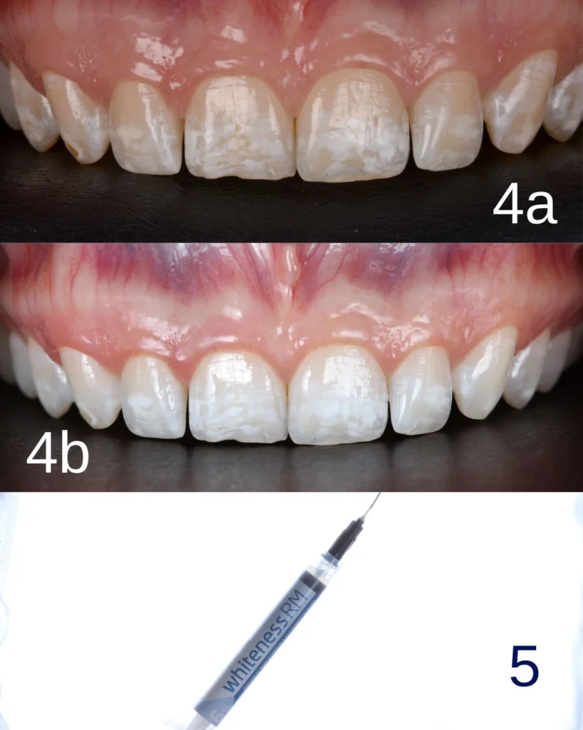 Antes e depois de um procedimento de clareamento dental, com dentes visivelmente mais brancos após a aplicação do produto Whiteness SMA.