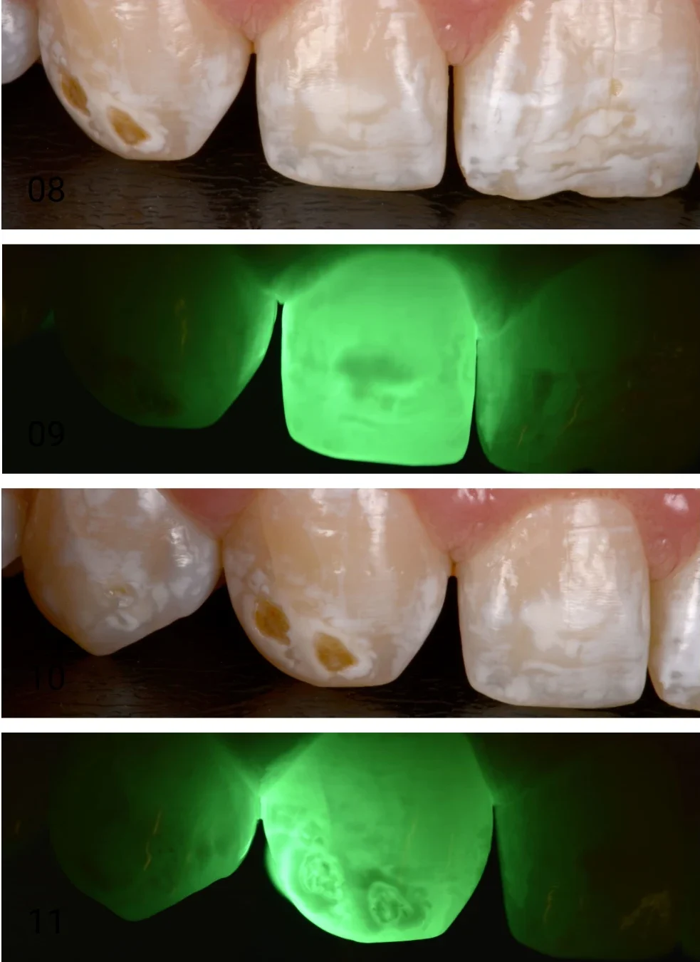 Diagnóstico de fluorose dental em grau moderado com presença de manchas mais intensas entre os dentes 13 ao 23.