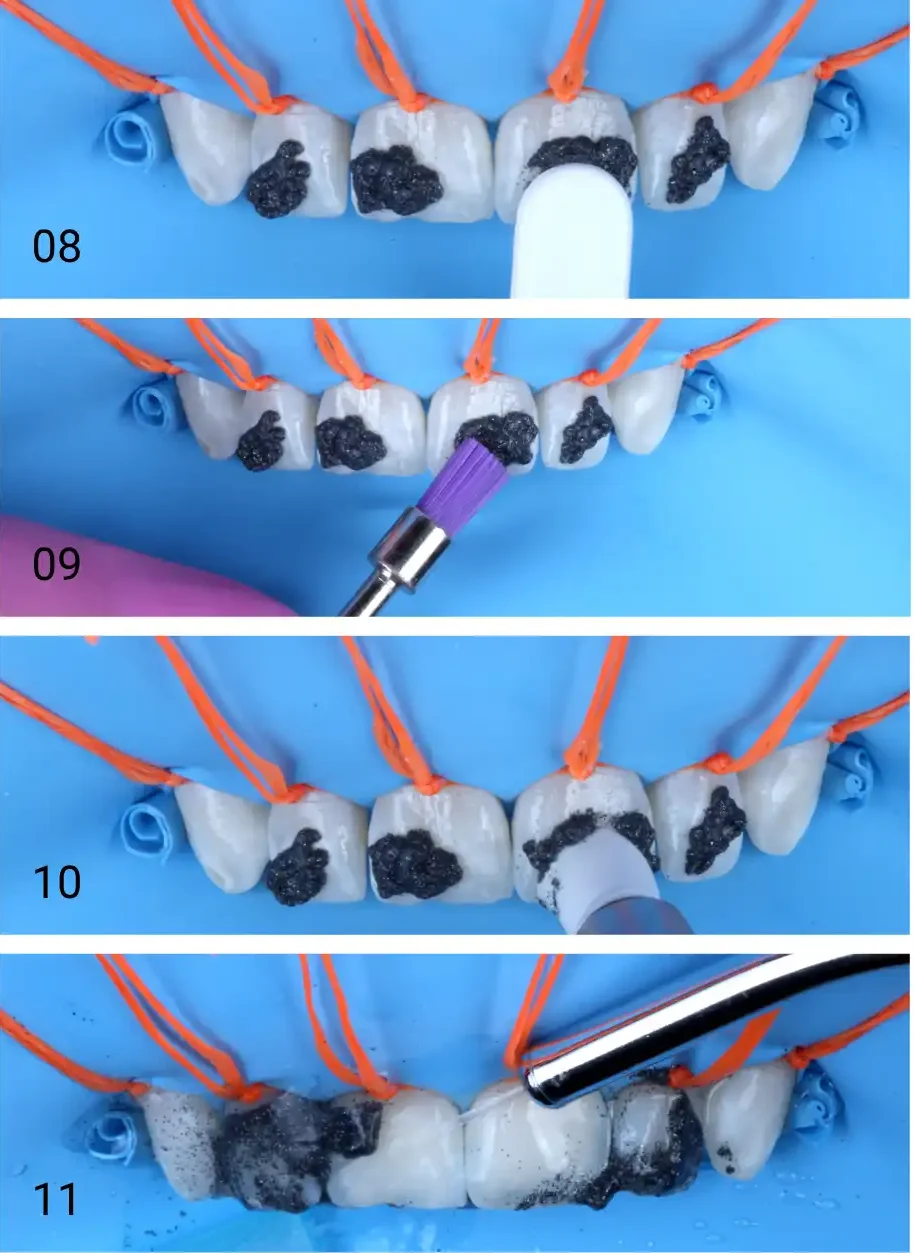Etapas do procedimento odontológico com dentes aplicação de materiais de limpeza usando ferramentas específicas, destacando o foco na estética dental.