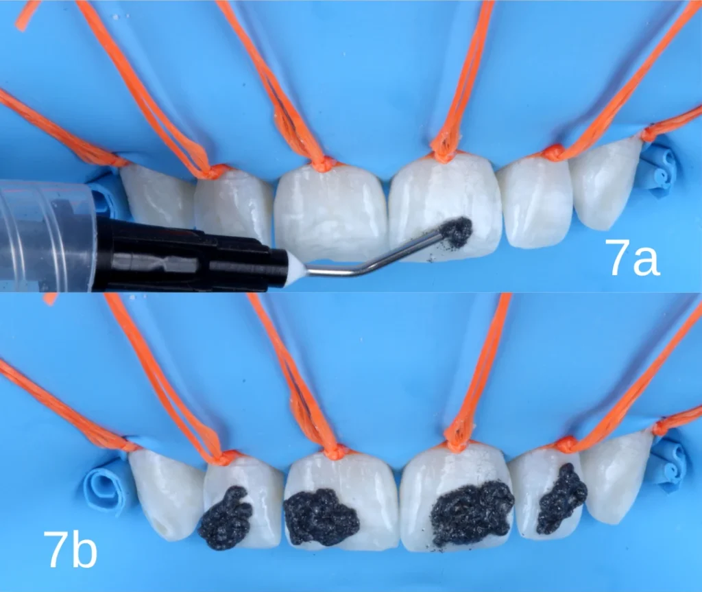 Whiteness RM sendo aplicado nos 6 dentes superiores para a remoção de manchas causadas pela fluorose dental