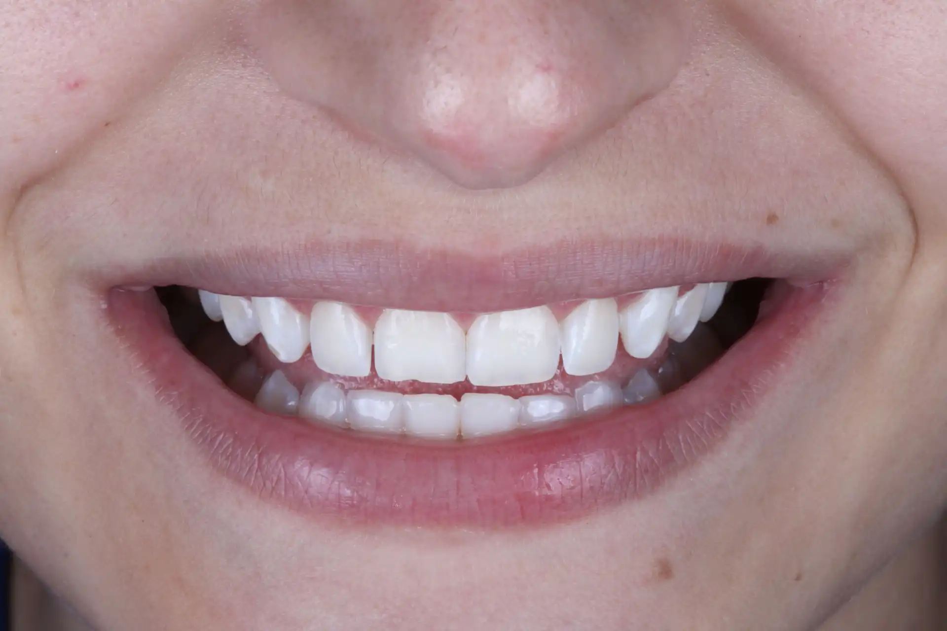 Sorriso com dentes brancos e alinhados, ressaltando cuidados com a higiene bucal e tratando a fluorose dentaria
