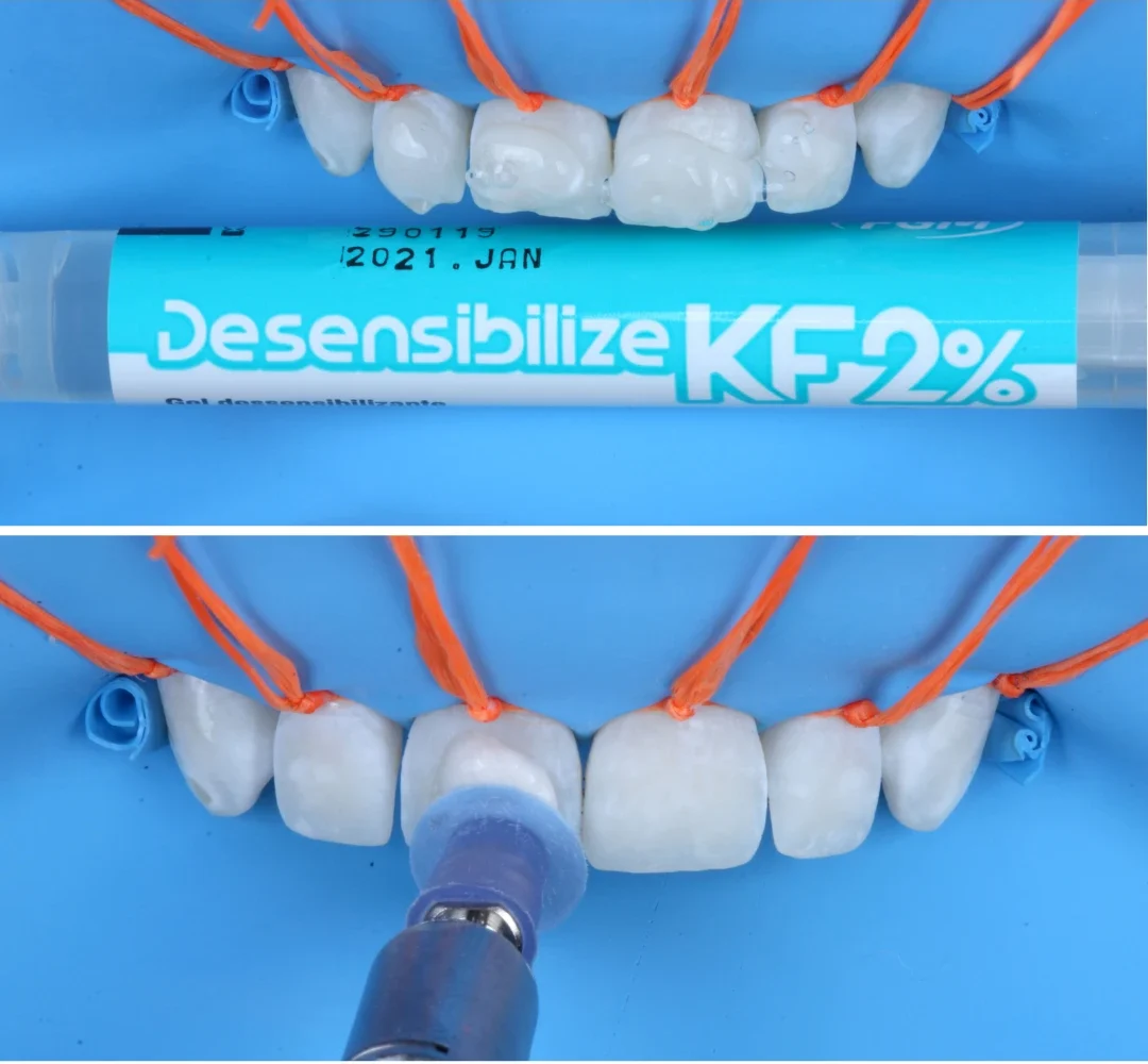 Tratamento odontológico para desintibilizar e fortalecer dentes com procedimento de aplicação de desensibilizante de ángulo azul na pequena moldeira de dentes. Processo realizado com ferramentas específicas em ambiente clínico.