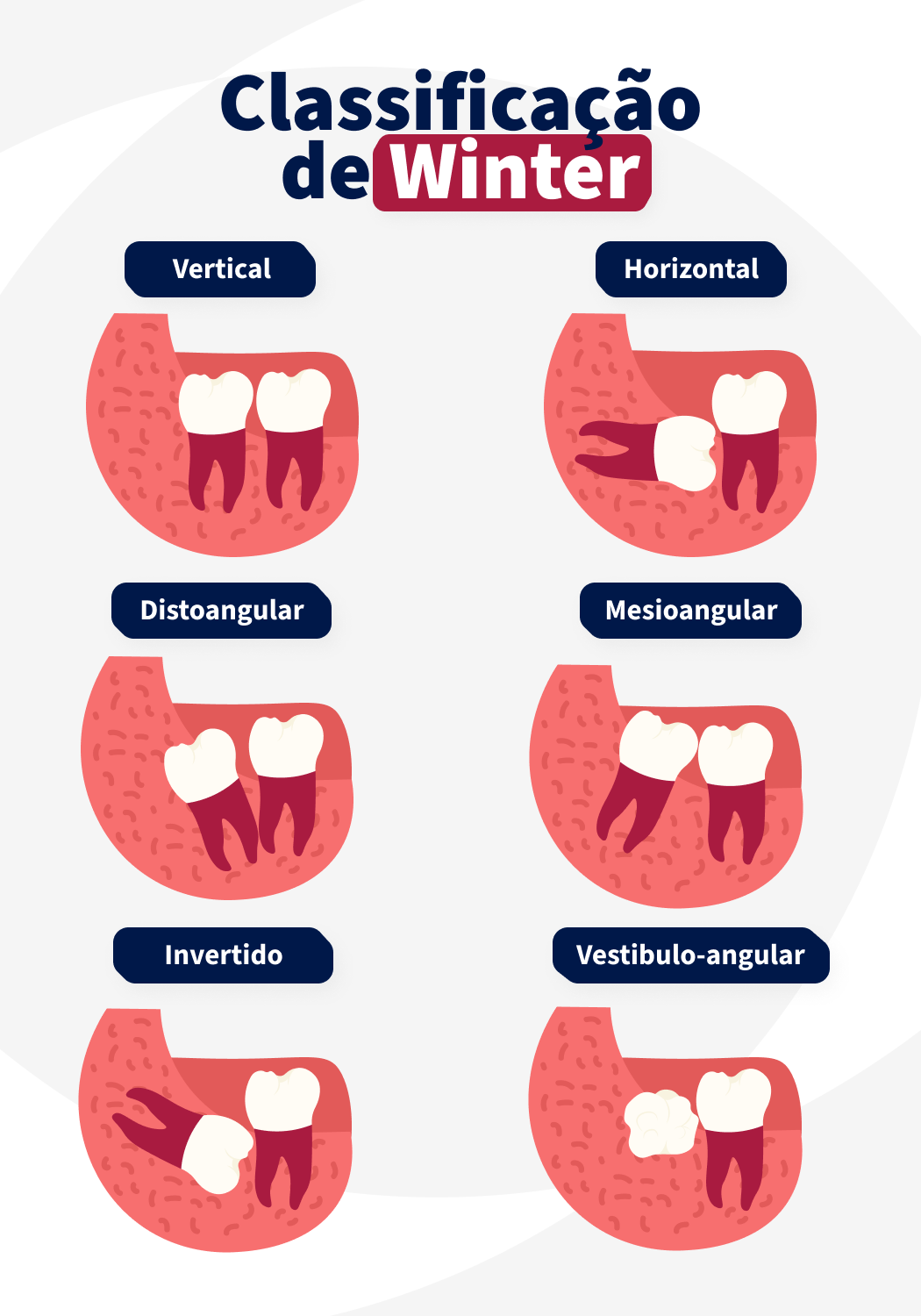 Infográfico explicativo sobre classificação de dentes de winter, incluindo categorias como vertical, horizontal, distoangular, mesioangular, invertido e vestíbulo-angular com ilustrações amigáveis para estudos.